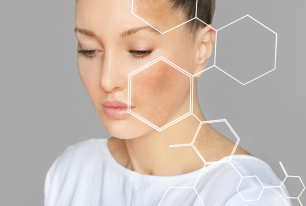 melasma-img1